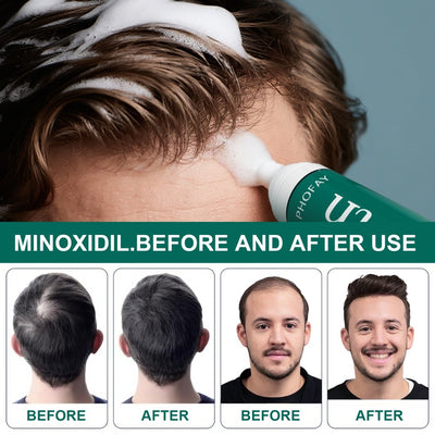CH004 Minoxidil Anti-Hair Loss Mousse